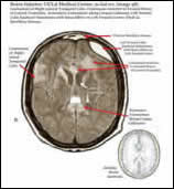 Orange County Traumatic Brain Injury Attorneys