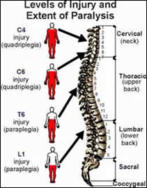 Orange County Spinal Cord Injury Attorneys